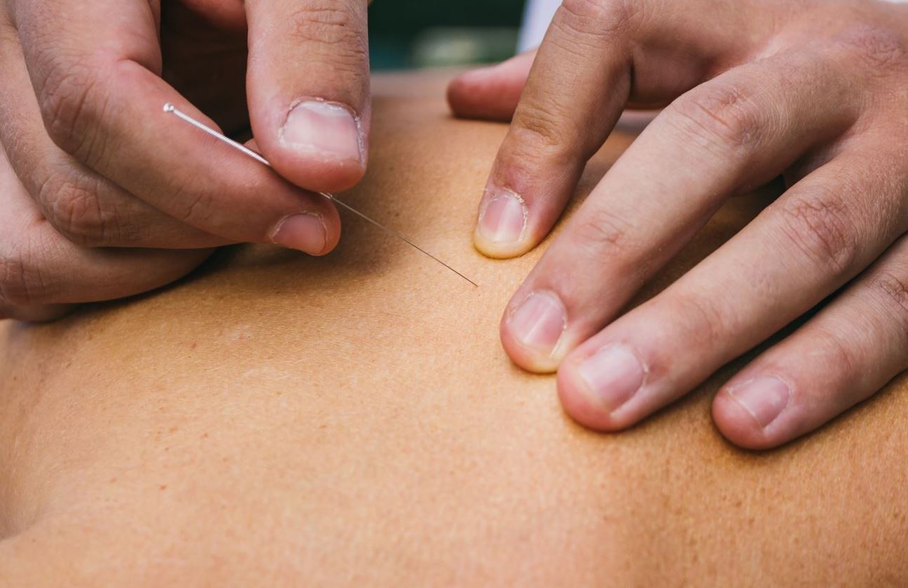 Dry needling Michiel Bonamie